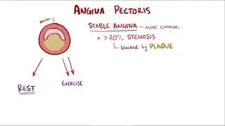 Angina pectoris ? stable unstable prinzmetal vasospastic and symptoms