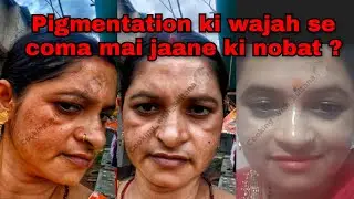 Pigmentation Khatam | Pigmentation Removing Bumper Remedy | Cooking with Sultana 