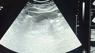 Сладж в желчном пузыре. biliary sludge, Билиарный сладж