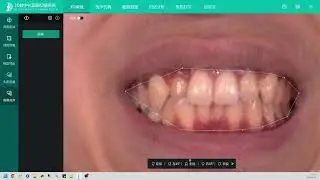 3D face scanner Bone alignment