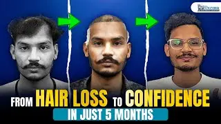 From Hair Loss to Confidence in 5 Months | Real Hair Transplant Transformation Story