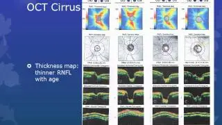 ONH and RNFL Imaging by Dr. Hannah de Guzman