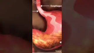 TREAT ACID REFLUX | GERD | ACIDITY NATURALLY #shortsfeed #shortsviral #shortsbeta