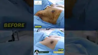 Struggling with chest fullness or male breast enlargement?Gynecomastia surgery offers an effective