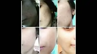 Gluta Arbuteen Anti Blemish Pigmentation Night Cream ☘️🌿🍀🍃