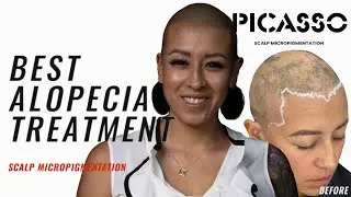 Scalp Micropigmentation | Best Alopecia Solution | Testimonial