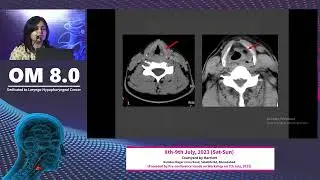 Imaging anatomy and common pathology of larynx and hypopharynx| Diva Shah| OM 8