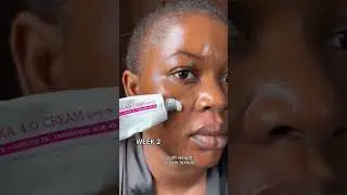 how to fade your dark spots or acne marks fast with tosowoong arbutin #skincare #viral
