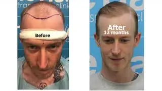 Lee's hair restoration journey by Dr Arshad FRCS