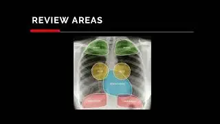 Acute Chest Pain - Dr Isa Azzaki Zainal