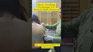 Micro Needling Technique For Stretch Mark Removal