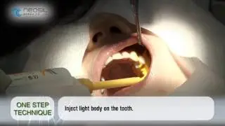 PEAKOSIL Dental Impression Materials manufactured by NEOSIL