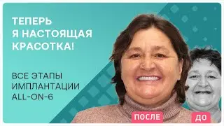 Все этапы all-on-6: новые зубы за 3 дня