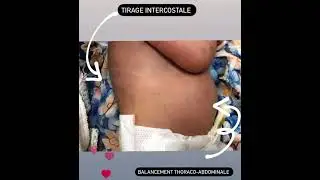 Balancement thoraco abdominale avec un tirage intercostale chez le nouveau n&eacute;