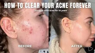 how to CLEAR your ACNE forever | hormonal acne, tiny bumps & clear skin tips