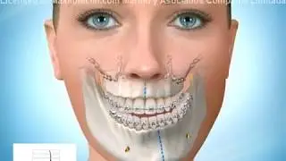 Cirugía Ortgnatica por Asimetría Facial (Bimaxilar)