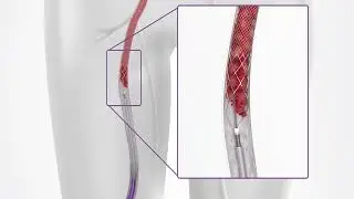 Deep Venous Thrombosis Treatment