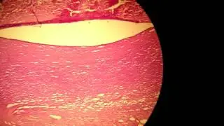 2- Myocardial infarction - Coagulative necrosis - Heart