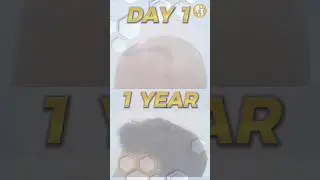 1 Year After SMART FUE  #baldnesssolution #fuehairtransplant #smartfue #fue #hairloss #hair
