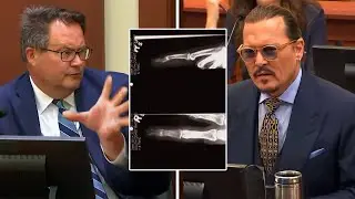 Finger Surgeon Actually APPROVES Johnny Depp&rsquo;s Story!