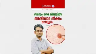 Dr. Devan Prakash explains how to effectively get rid of warts. #WartRemoval #gghospital