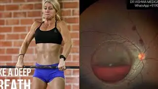 Sudden vision loss in gym? Valsalva retinopathy- what is it? What can be done? How to avoid 