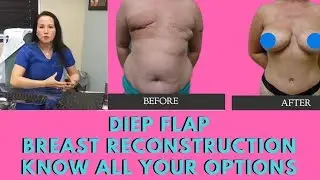 The Benefits of The DIEP Flap Surgery | Breast Cancer Reconstruction | Dr Anh Lee