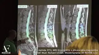 Je ozonterapia vhodn&aacute; pri vyskočenej platničke
