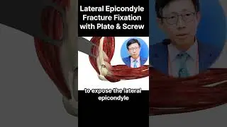 Optimizing Stability: Plate and Screw Fixation for Lateral Epicondyle Fractures 외상과 골절의 안정화: 금속판 고정술