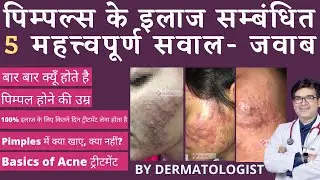 Acne Treatment | पिम्पल्स का इलाज | 5 Common Important Facts About Acne Treatment