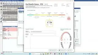 Voice Enabled Perio Charting & PHI Reporting for Open Dental with Denti AI Voice