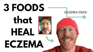 3 FOODS that heal ECZEMA
