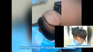 Hair fixing Bangalore. (Rajaji Nagar) , weaving type of hair fixing. Call 9110221804/9742549827