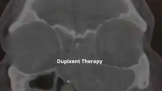 Dupixent Therapy Before & After  | ENT New Orleans Metairie Chalmette | GNO Snoring & Sinus