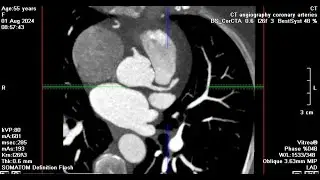 80 Kv  cardiac CT, Retrospective ECG gating with mA modulation (window from 60 -80 %) DLP= 196 mGycm