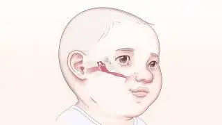 Ear Infections in Children and Ear Tubes Explained! Patient Education Myringotomy & Tympanostomy