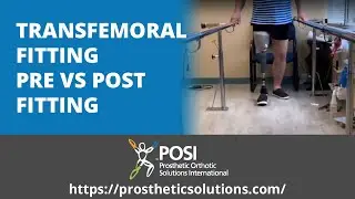 TransFemoral Fitting Pre vs Post | Prosthetic Orthotic Solutions International