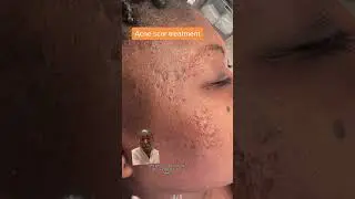 Как я лечу атрофические рубцы от угревой сыпи на темной коже #эстетическаямедицина #уходзачернойк...