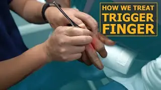 How We Treat Trigger Finger | Physical Therapy