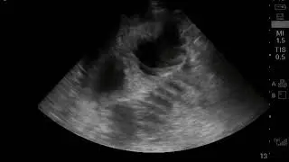 Small Bowel Obstruction