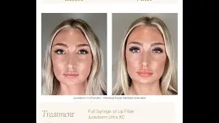 Juvederm in Chandler - Flawless Faces MedSpa Chandler