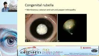 KSOS2023   IC78  Topic Dr Naveen S  Etiopathogenesis of pediatric cataract and how it is different f