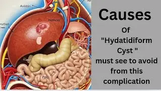 Danger from Dirty Food? Liver Cyst Explained,Shocking Cause of This Liver@ healthcorner with experts