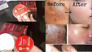 How To Get Rid of Acne Pimples Dark Spots pigmentation Honest review|  Stillman's Frackle Cream 