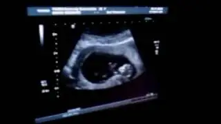 11 weeks and 3 days