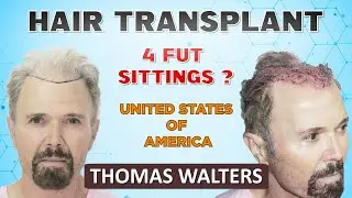 Hair Transplant in India for USA patients after 4 Hair Transplant in USA | at Medispa | Dr Suneet