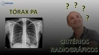 T&oacute;rax PA  - Crit&eacute;rios Radiogr&aacute;ficos: Garantindo Imagens de Qualidade para o Diagn&oacute;stico