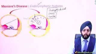 1  Ear 15  Diseases of Inner Ear atf