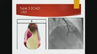 Christina Thaler, MD - Spontaneous Coronary Artery Dissection: Unraveling an Enigma