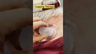 Cupping Therapy for Neck Pain